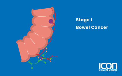 Illustration of Bowel Cancer Stage 1