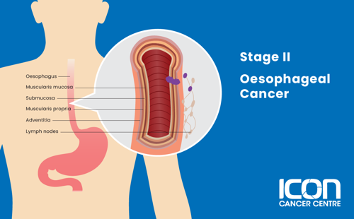 Stage II oesophageal cancer illustration