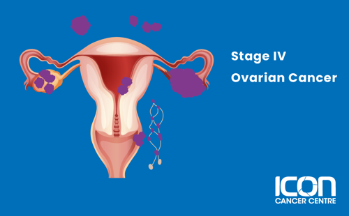 Stage IV ovarian cancer illustration