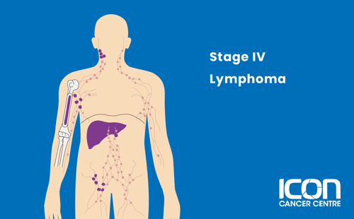 Stage IV lymphoma illustration