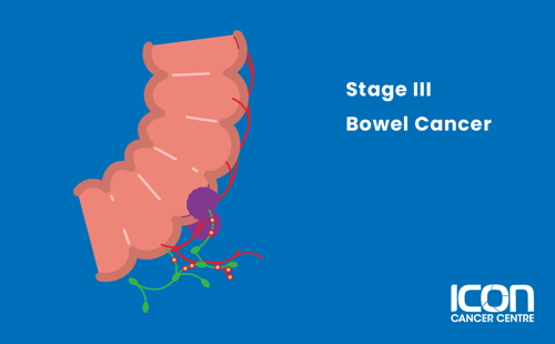 Illustration of Bowel Cancer Stage 3